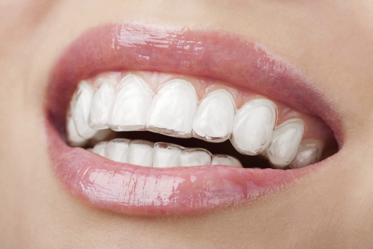 Common Cosmetic Dentistry Procedures | Bell Dentist